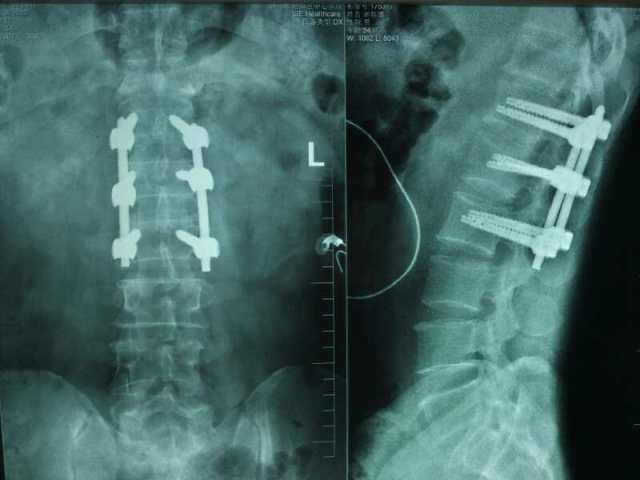 腰椎骨折经皮椎弓钉内固定骨折闭合复位术病人术后片